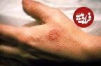 اگزمای پوست سر چیست و چگونه درمان می‌شود؟