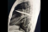 چاقویی که هشت سال در «سینه» مخفی مانده بود