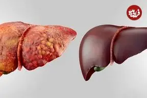 سرکه، آبغوره و ادویه برای کبد چرب خوب هستند یا بد؟