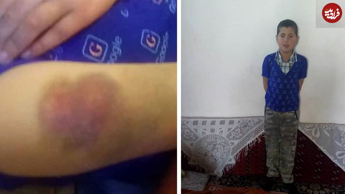 تنبیه بدنی دانش آموز ۹ ساله به دست معلم