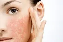 چه عوامل باعث خشکی پوست می‌شوند؟