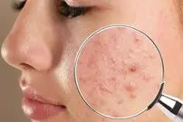 توصیه‌های بهداشتی برای درمان آکنه و جوش صورت؛ با جای جوش‌ها چه کنیم؟