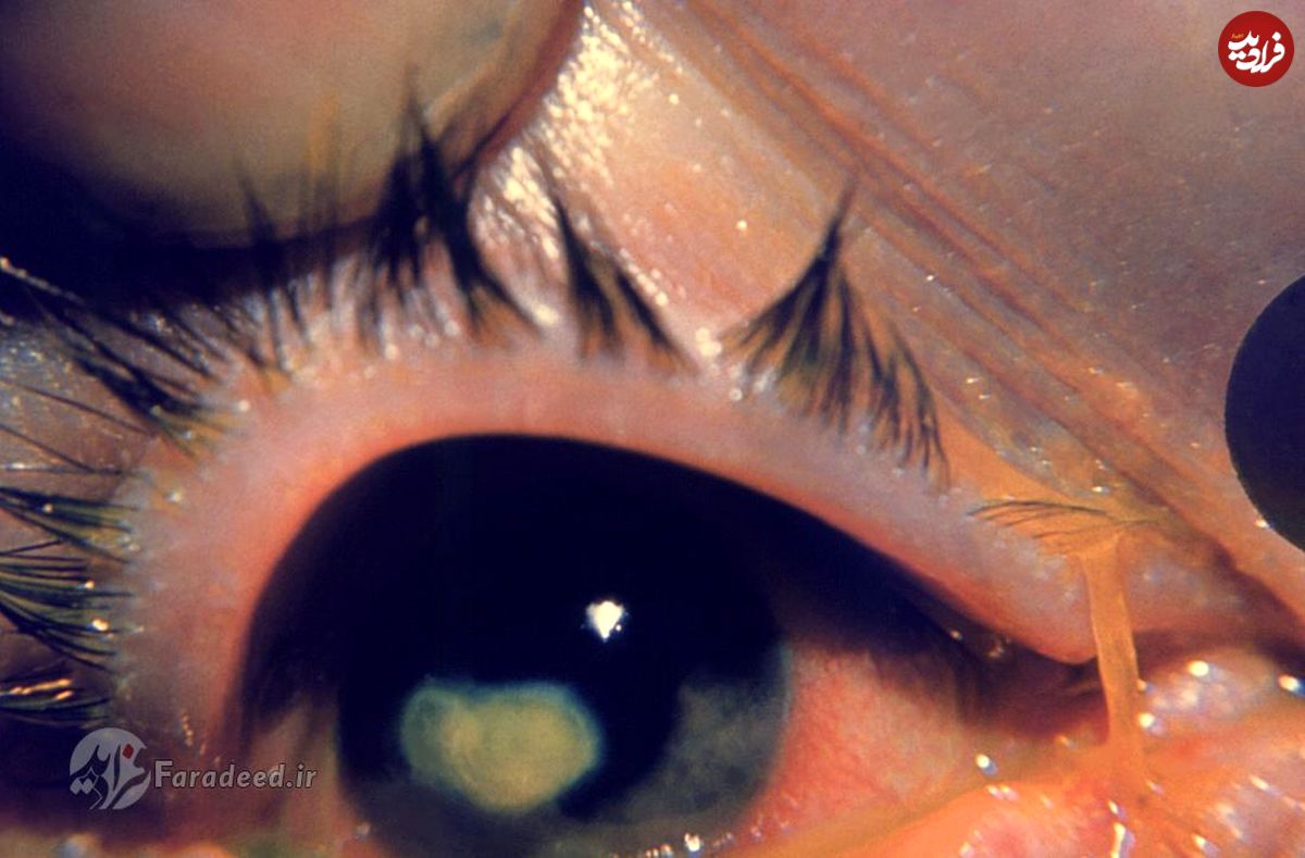 روش های درمان ترشحات چشمی؛ علت قی کردن چشم چیست؟