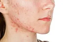 هشدار؛ ۵ نشانه پوستی را جدی بگیرید!