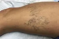 چگونه می‌توان از ظاهر شدن رگ‌های واریسی جلوگیری کرد؟