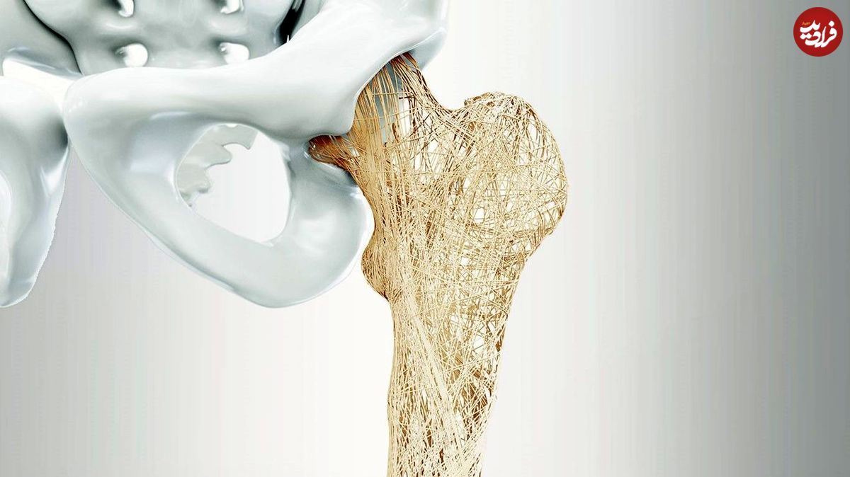 درمان پوکی استخوان با هورمون‌های طبیعی