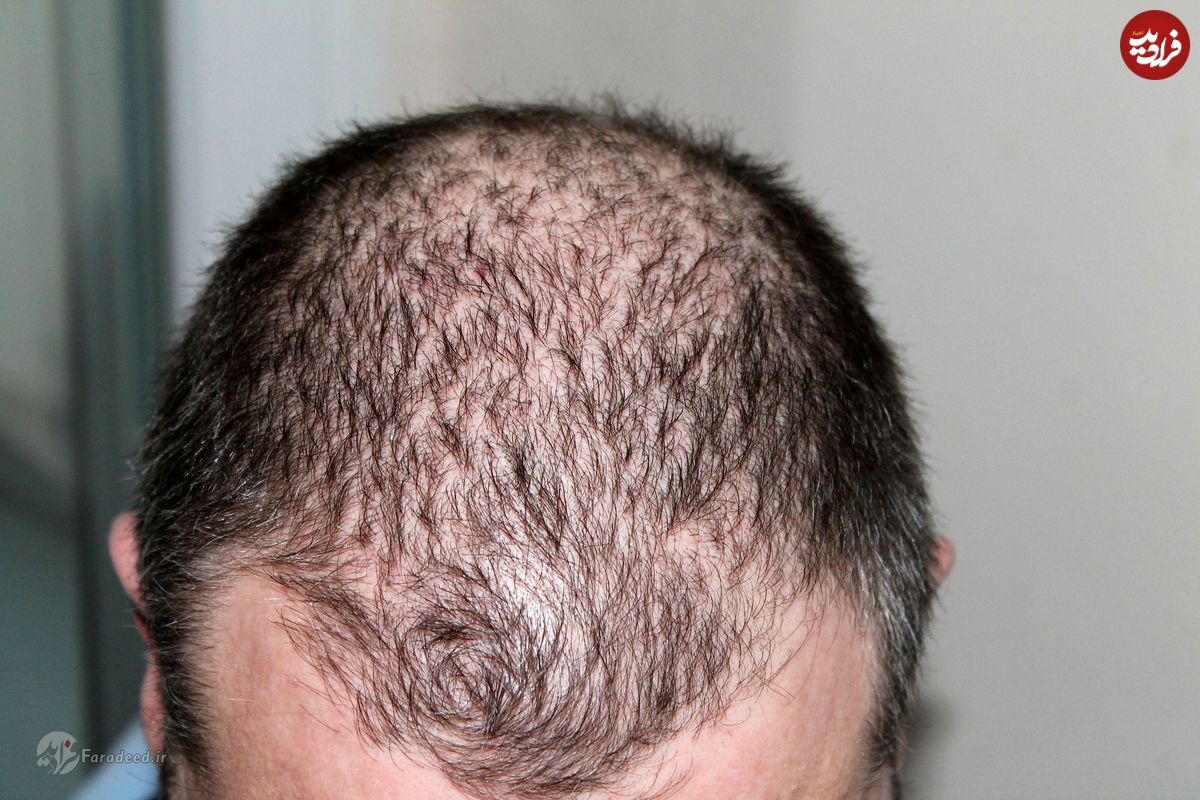 آیا ریزش موی ارثی درمان دارد؟