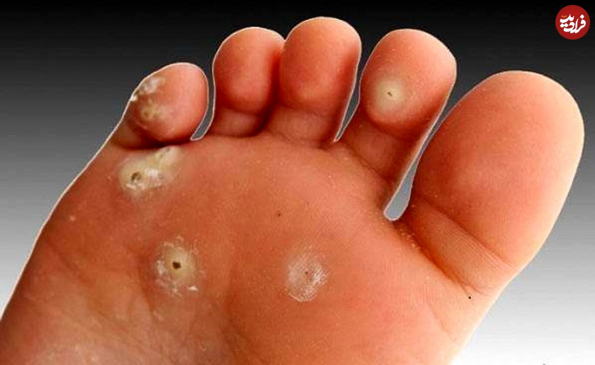 «میخچه» را چگونه درمان کنیم؟