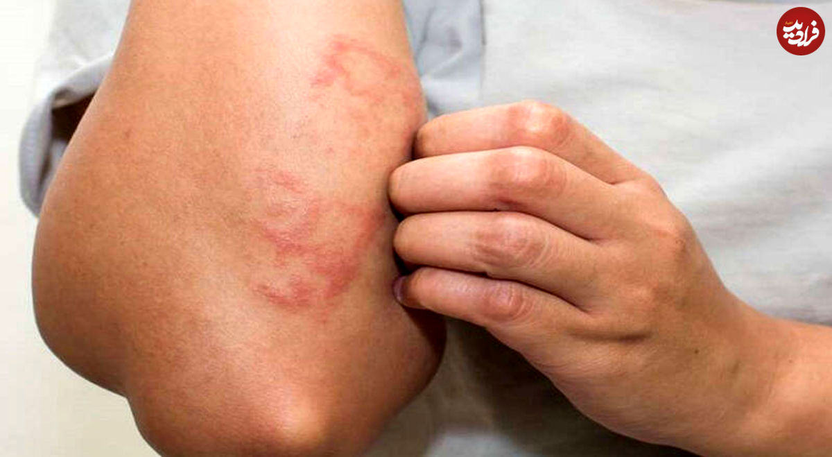 علت بروز ضایعات پوستی در برخی مبتلایان به کرونا