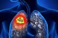 دانشمندان نقطه ضعف سرطان ریه را کشف کردند