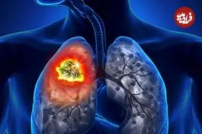 دانشمندان نقطه ضعف سرطان ریه را کشف کردند