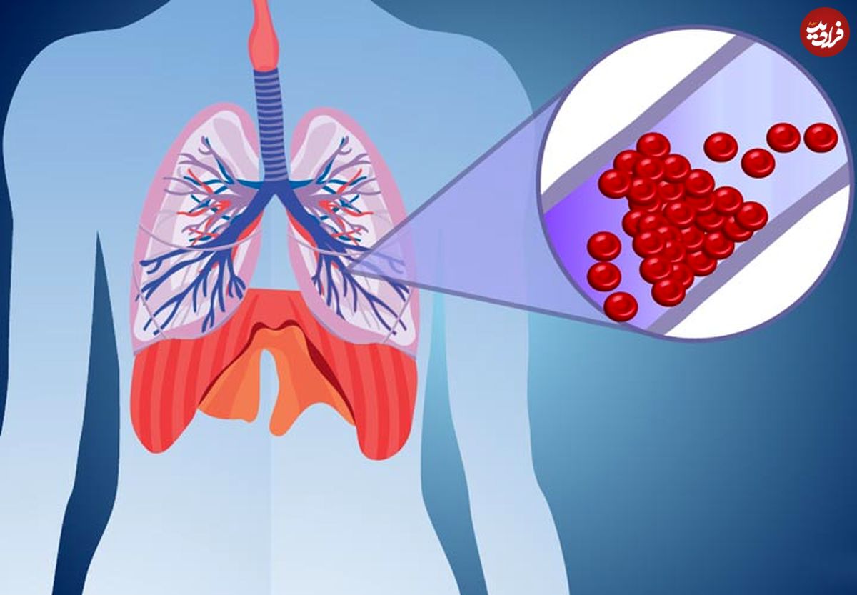 آمبولی ریه چیست؟؛ سوالات رایج درباره علائم، تشخیص و درمان آمبولی ریه