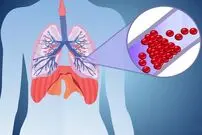 آمبولی ریه چیست؟؛ سوالات رایج درباره علائم، تشخیص و درمان آمبولی ریه