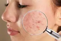 راه‌های سریع کاهش آکنه و جوش روی صورت