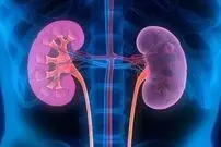 چگونه می‌توان از ابتلا به سنگ کلیه پیشگیری کرد؟