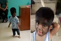 (تصاویر) پرموترین پسر جهان که مبتلا به «سندرم گرگینه» است