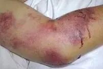 مرگ قصاب بندرعباسی بر اثر تب کریمه کنگو