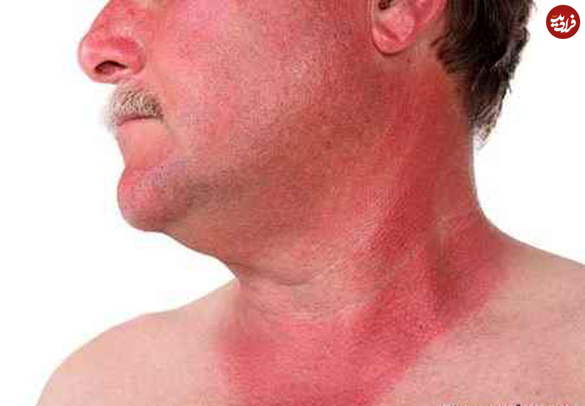 روش هایی عالی برای درمان آفتاب سوختگی