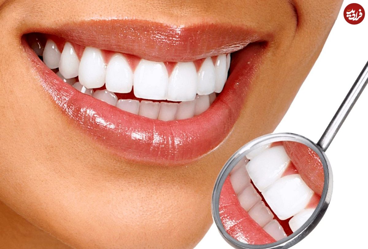 بهترین روش‌های سفید کردن دندان‌ها