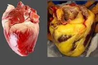 قلب چاق؛ افراد لاغر هم در خطر هستند؛ توصیه انجمن قلب آمریکا چیست؟