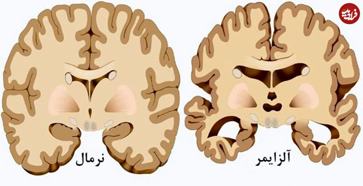 کشف مهم دانشمندان در مورد آلزایمر