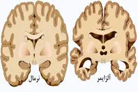 کشف مهم دانشمندان در مورد آلزایمر