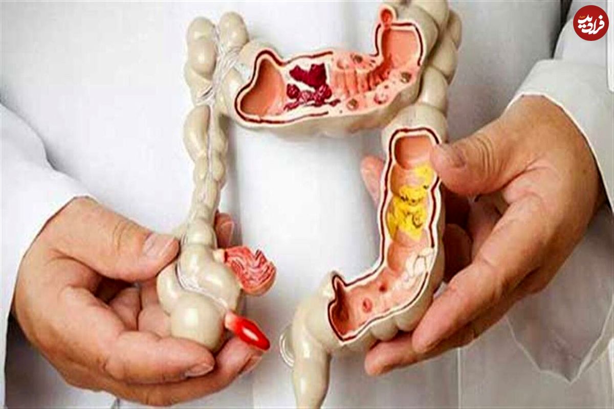 غربالگری اولیه سرطان روده بزرگ جان هزاران نفر را نجات میدهد