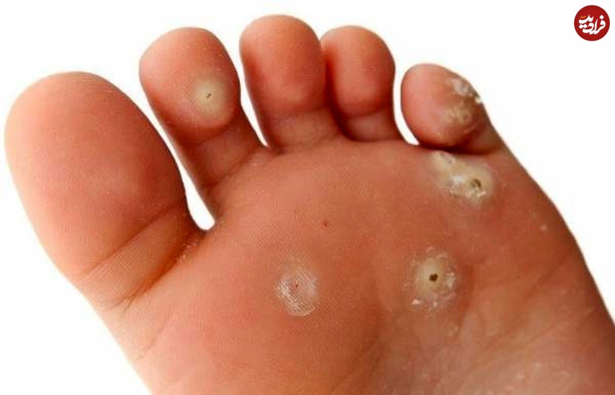 ۱۲ راه طبیعی برای درمان میخچه پا