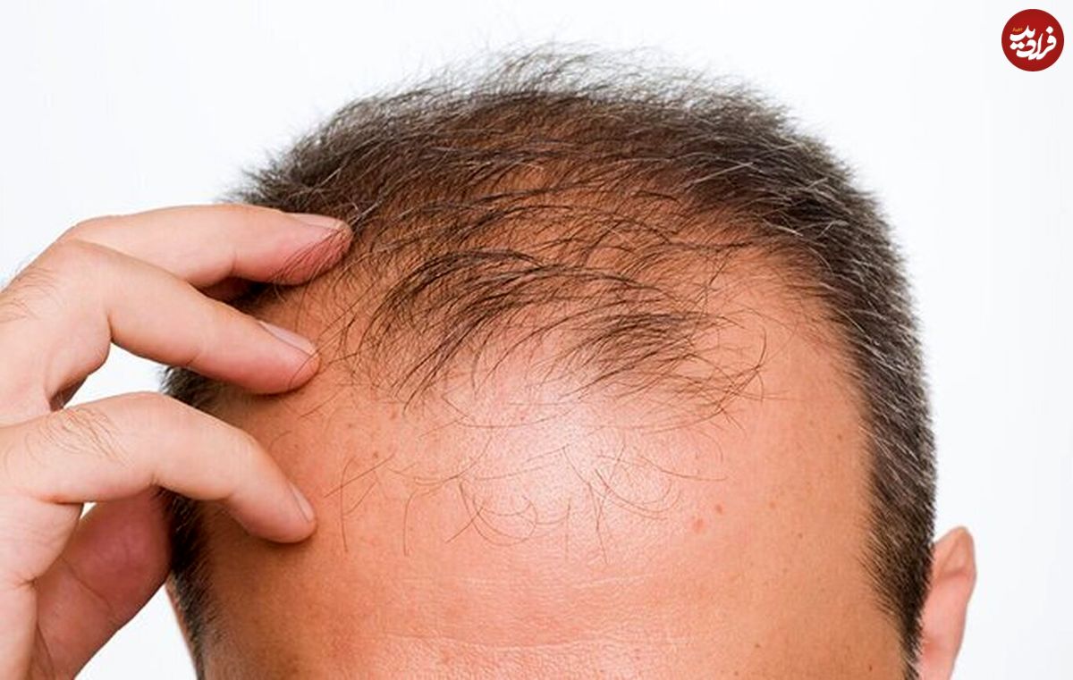 این عامل تشدیدکننده ریزش مو در مردان را بشناسید