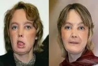 عکس/ اولین دریافت کننده پیوند صورت در جهان درگذشت