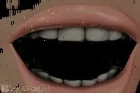 عکس/ ایمپلنت دندان چطور صورت می‌گیرد؟