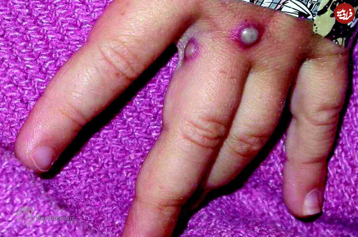 هشدار جهانی درباره «آبله میمون»
