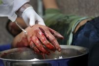 ٧ بار جراحی روی دست نارنجک‌ساز
