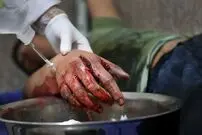 ٧ بار جراحی روی دست نارنجک‌ساز