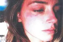 آثار کبودی روی صورت همسر جانی دپ