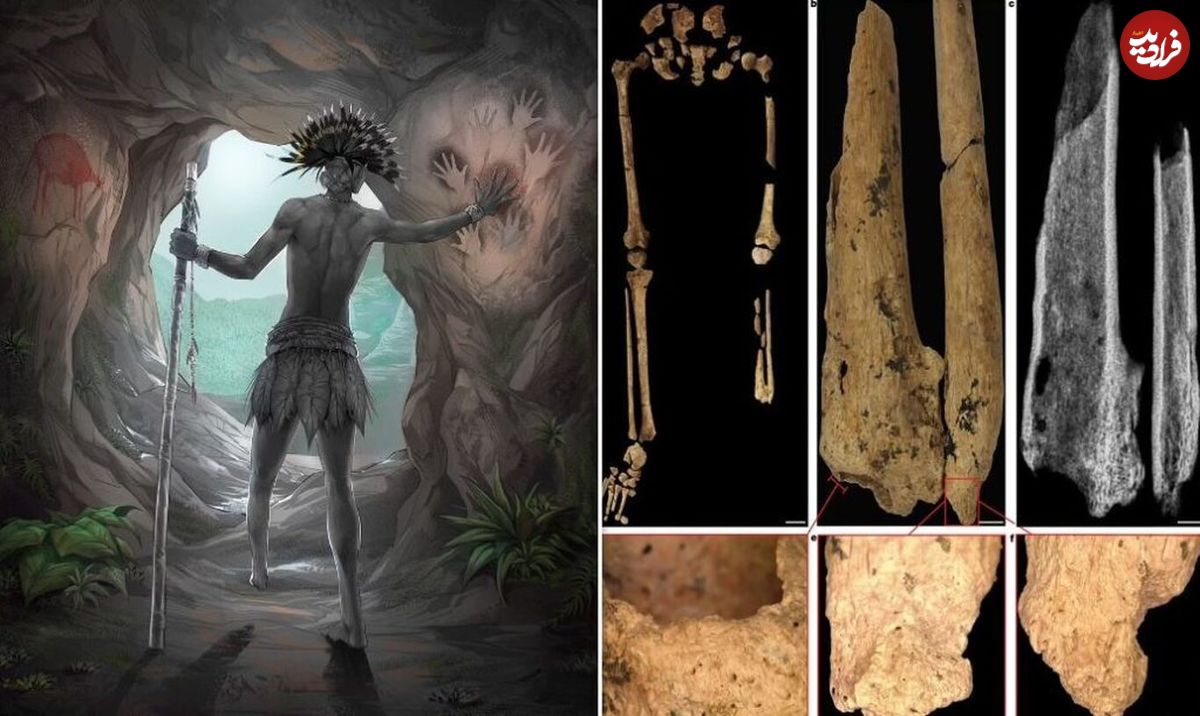 اولین و عجیب‌ترین جراحی تاریخ، ۳۱ هزار سال پیش در غار