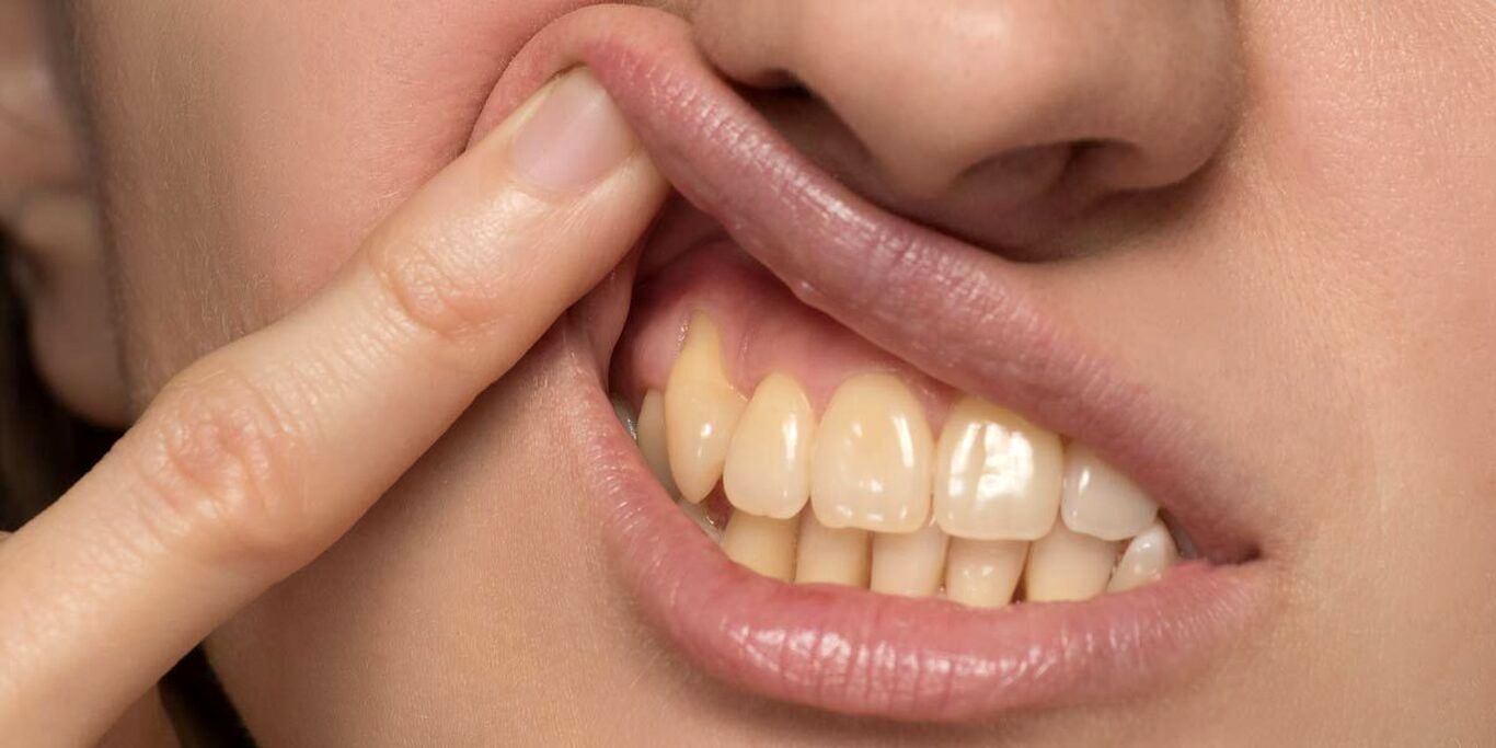 عادت‌های غلطی که دندان‌های شما را زرد می‌کند