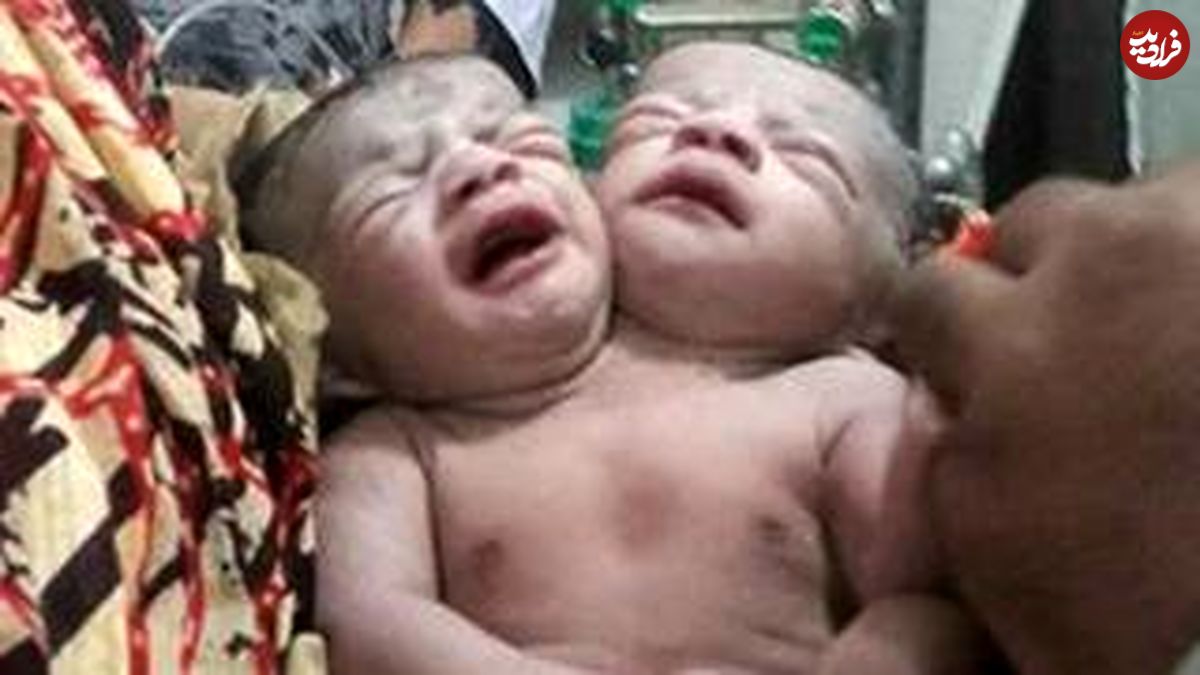 تولد نوزاد شگفت‌انگیز در بنگلادش با دو سر