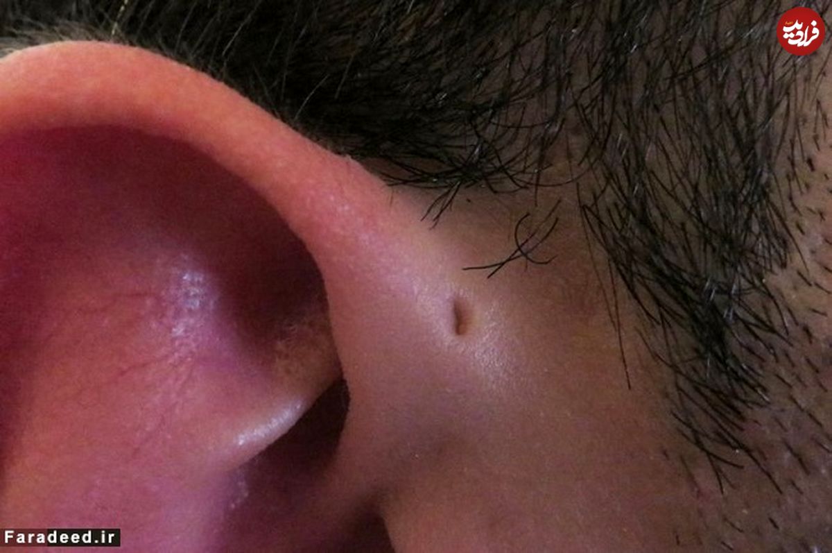 علت وجود سوراخ ریزِ روی گوش چیست؟