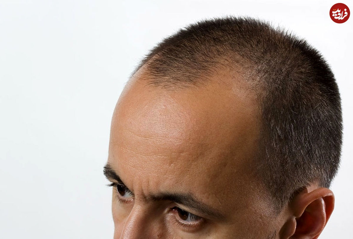 ۱۰ توصیه مهم قبل از اقدام به کاشت مو