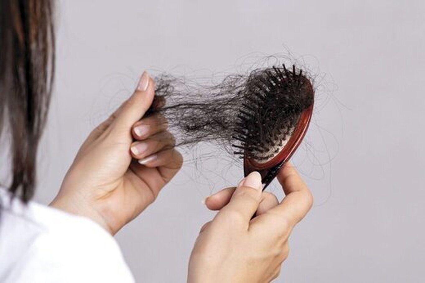 علائم ریزش مو کدامند؟ این ریزش مو مخصوص زنان است