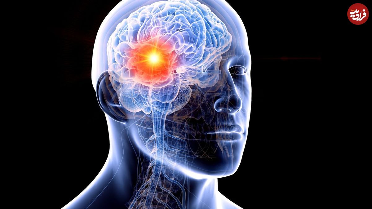 علائم تومورهای سرطانی مغز