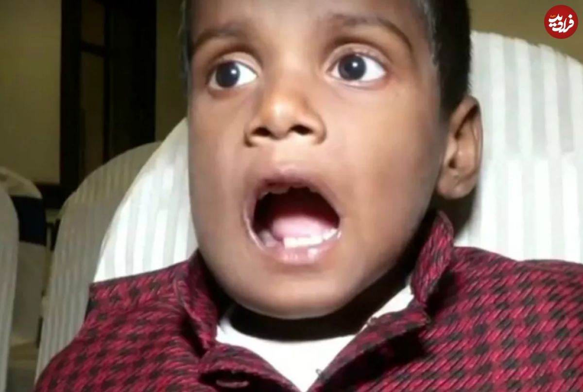  (ویدئو) کشف ۵۲۶ دندان در دهان کودک هندی!
