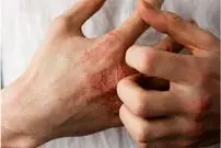 توصیه‌هایی درباره یک عارضه پوستیِ شایع