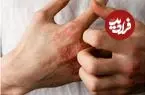توصیه‌هایی درباره یک عارضه پوستیِ شایع