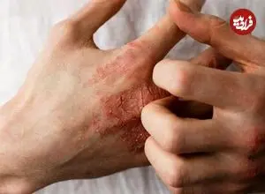 توصیه‌هایی درباره یک عارضه پوستیِ شایع