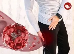 لخته شدن خون در پا چه خطراتی دارد؟ از عوارض مزمن تا مرگ ناگهانی