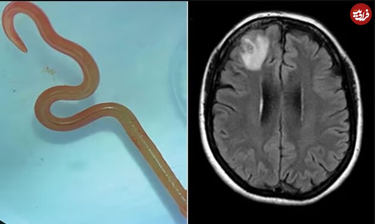 ( عکس) کشف بی‌سابقه کرم زنده در مغز یک بیمار؛ مارهای پیتون میزبان این انگل هستند