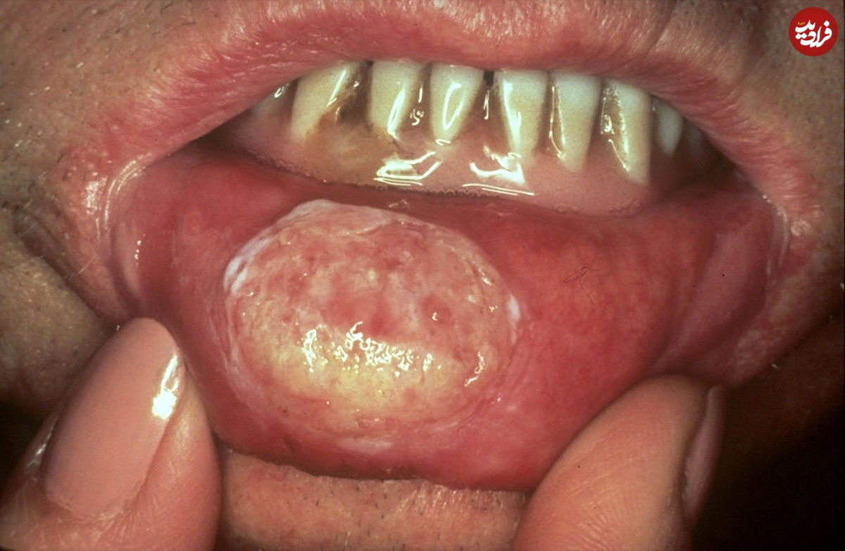 علایم سرطان دهان را بشناسید