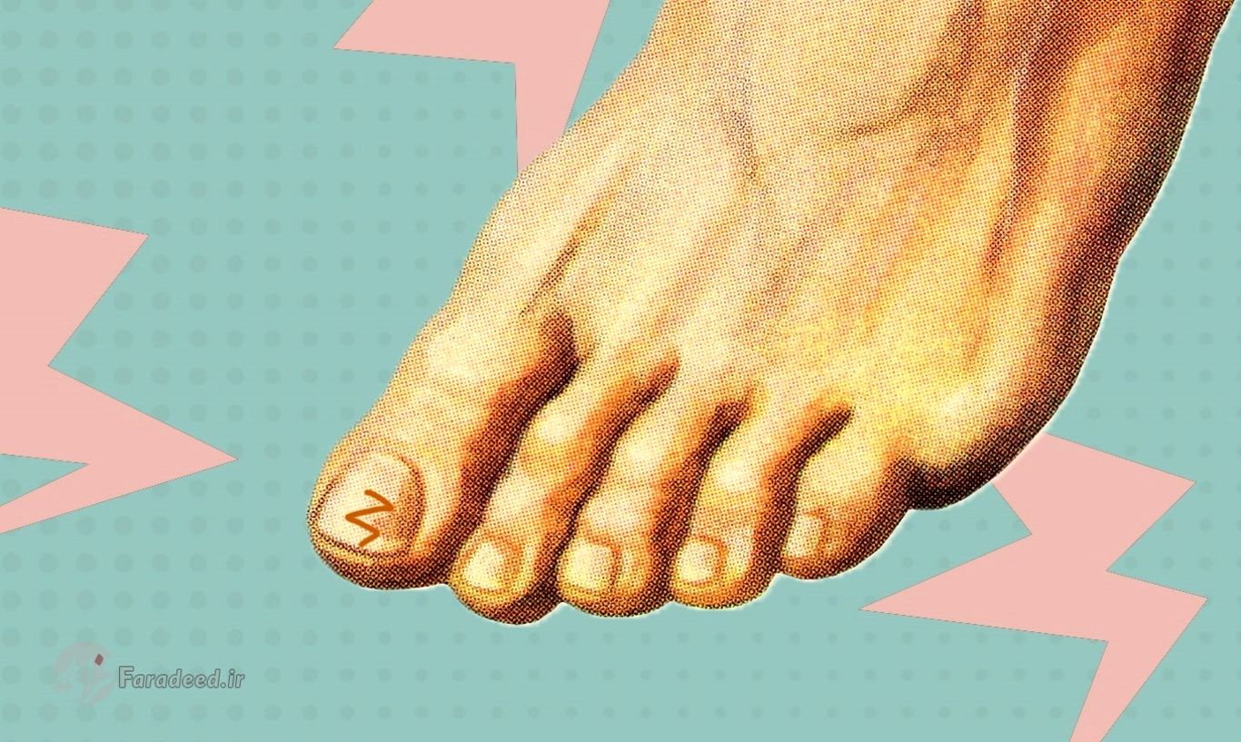 درمان سیاه شدگی ناخن پا؛ علت سیاه شدن ناخن پا چیست؟